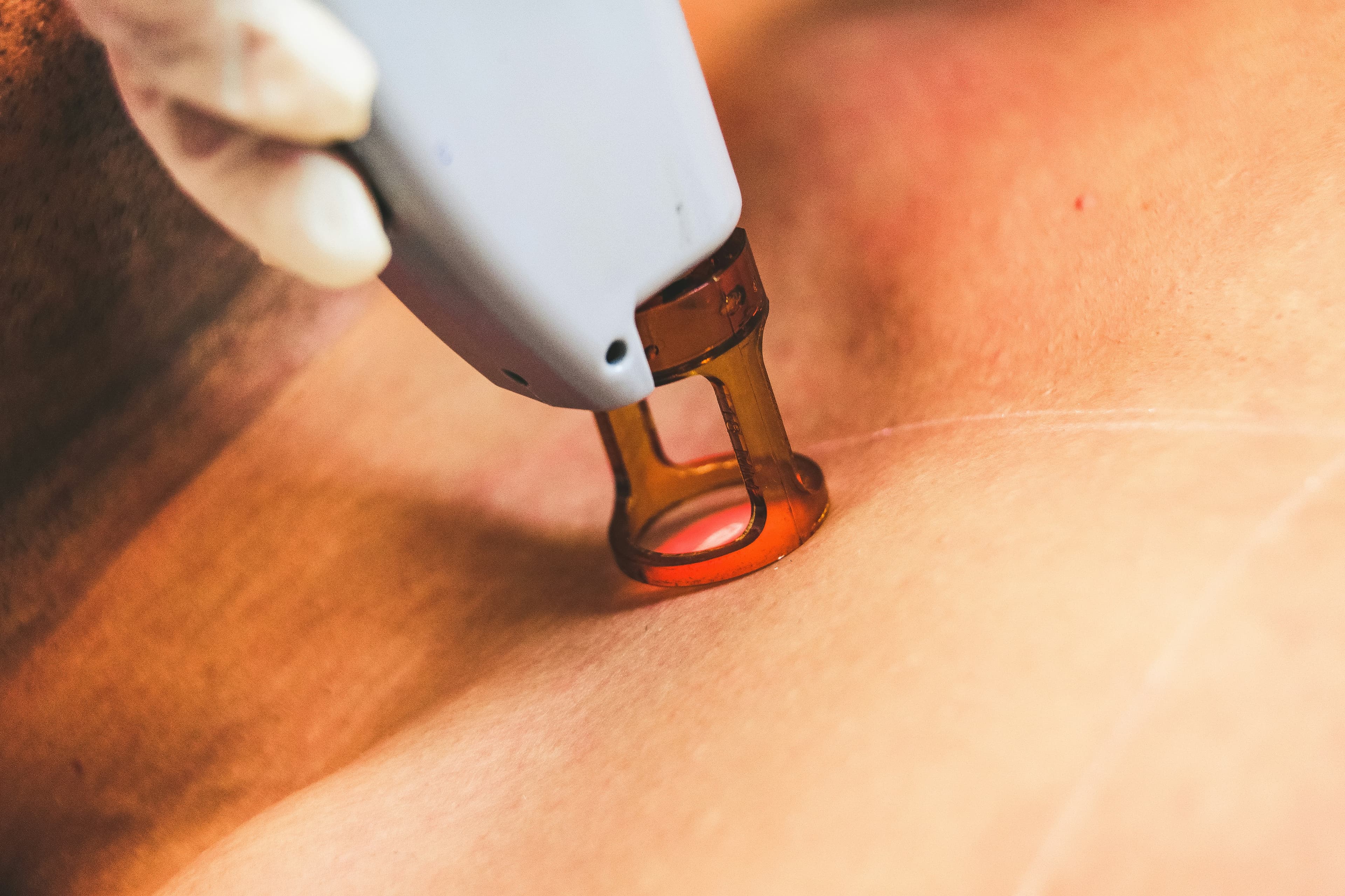 Laser hair removal treatment being applied to skin